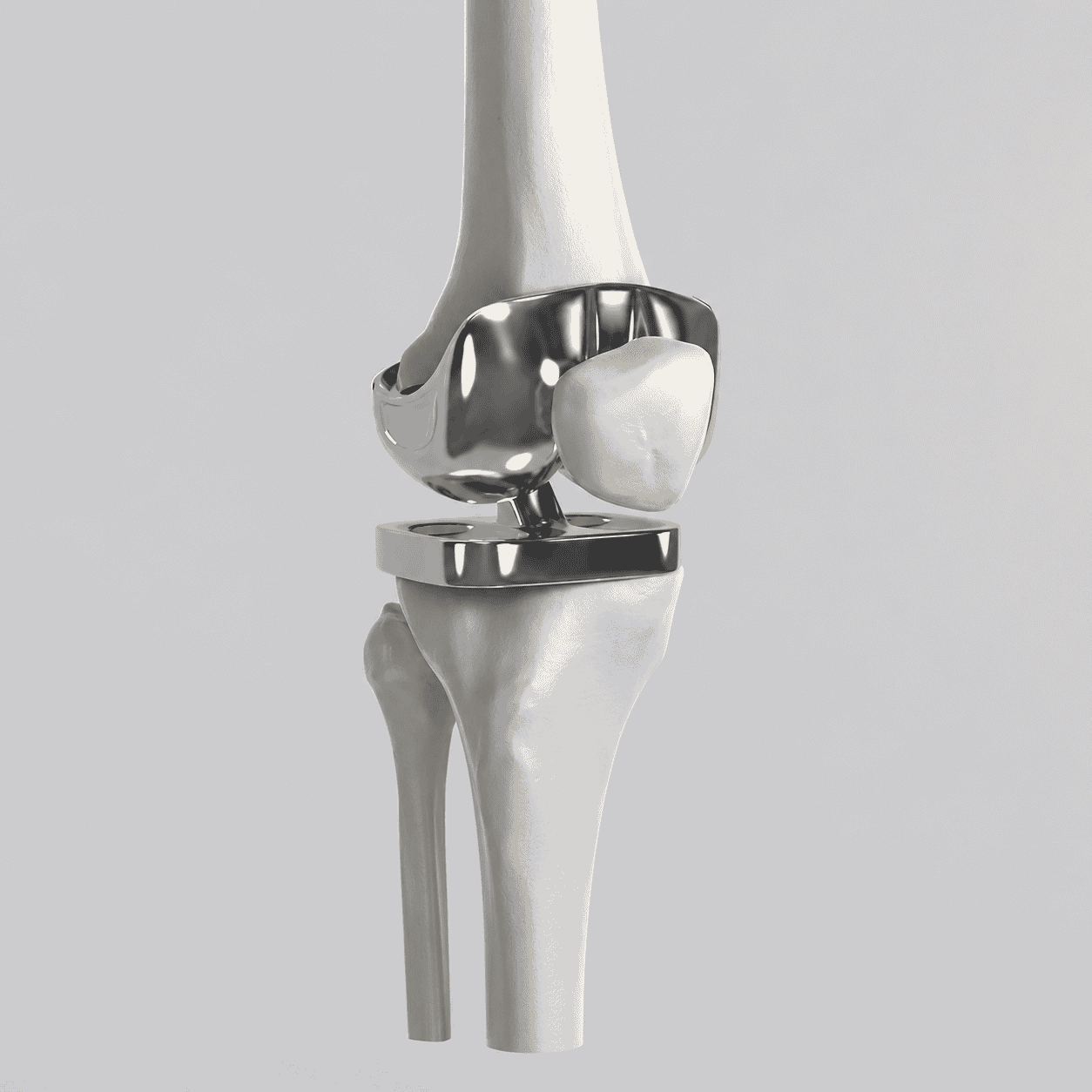 A total knee joint replacement